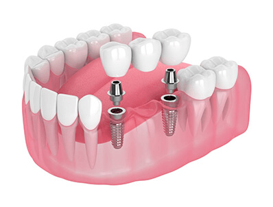 Dental Implant Image