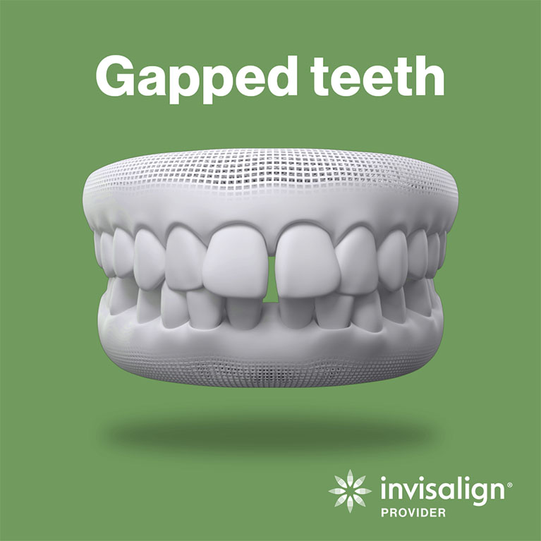 Gapped Teeth