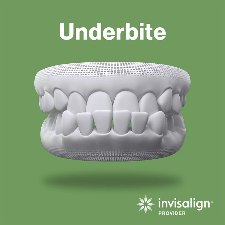 Underbite Teeth